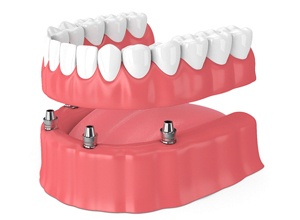 Illustration of implant denture for lower arch against white background
