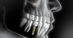 Illustration of implant that has integrated with surrounding bone