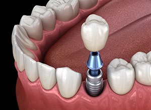 Dental implants in Meriden replace the full structure of your tooth. 