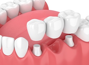 Graphic of dental bridge