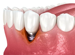 Digital image of receding gums around a dental implant
