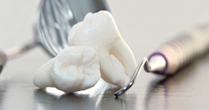 Close-up of two extracted wisdom teeth with dental instruments