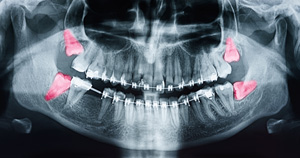 Dental X-ray showing four extracted wisdom teeth