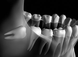 Graphic of wisdom tooth