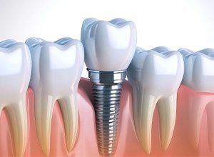 Illustration of dental implant between natural teeth
