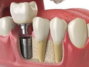 Diagram of a placed dental implant in Meriden
