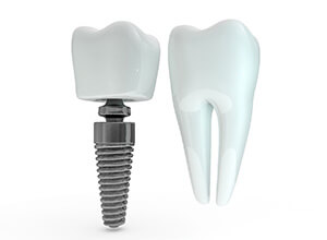 Model dental implant in Meriden beside model natural tooth