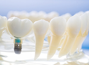 Model teeth and jaw with dental implant in Meriden