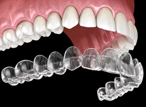 Illustration of Invisalign being placed on upper dental arch