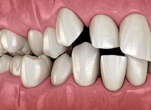 Illustration showing close-up of crowded teeth