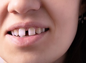 Close-up of person’s smile with a gap between their front teeth