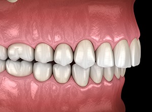 Side-view digital image showing an overbite