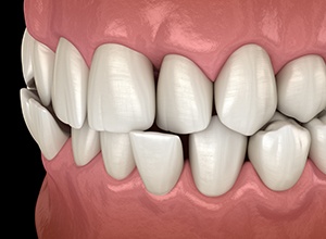 Digital illustration of a crossbite