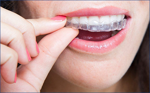 Patient inserting Invisalign tray