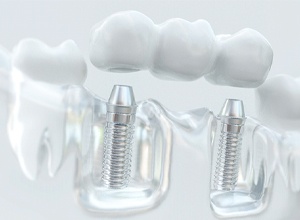 implant-supported bridge