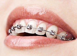 Close-up of woman’s smile with traditional braces in Meriden
