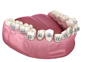 Illustration of crooked teeth wearing traditional braces