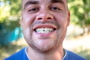 Smiling man with a chipped front tooth 