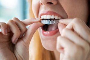 Woman placing Invisalign aligner on her top teeth 