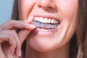 Close-up of woman’s mouth as she places Invisalign on her teeth