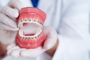 Dental model with traditional braces in Meriden on top and bottom