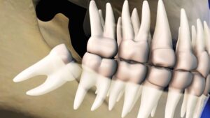 Illustration showing an impacted wisdom tooth