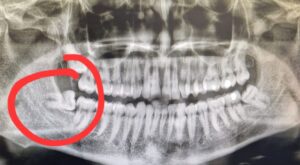 X-ray showing a sideways wisdom tooth