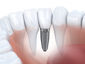 Bridges replace one or more teeth.